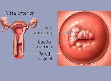 vph mujeres wikipedia